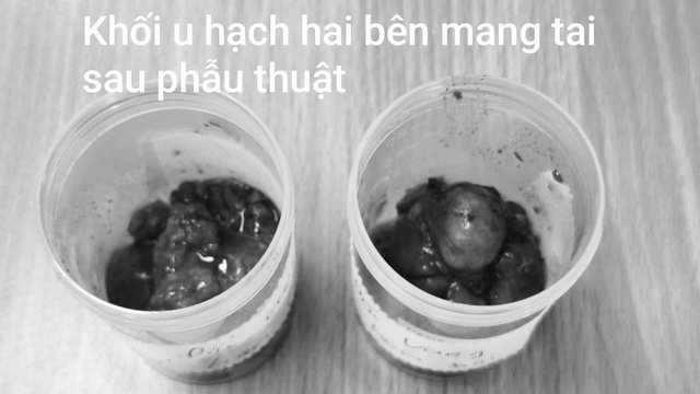 Hàm sưng to, cụ ông tái phát u tuyến nước bọt sau gần 10 năm- Ảnh 4. Hàm sưng to, cụ ông tái phát u tuyến nước bọt sau gần 10 năm- Ảnh 4.