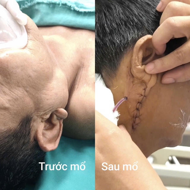 Hàm sưng to, cụ ông tái phát u tuyến nước bọt sau gần 10 năm- Ảnh 3. Hàm sưng to, cụ ông tái phát u tuyến nước bọt sau gần 10 năm- Ảnh 3.