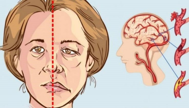 Tai biến mạch máu não: Nguyên nhân, triệu chứng và giải pháp phòng ngừa- Ảnh 2. Tai biến mạch máu não: Nguyên nhân, triệu chứng và giải pháp phòng ngừa- Ảnh 2.