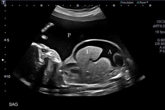 Thai nhi bị thiếu máu: Nguy cơ tử vong và giải pháp đột phá từ y học bào thai- Ảnh 1.