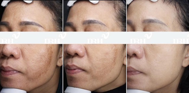 Không cần thực hiện xâm lấn, Dr.Huy Clinic làm chủ xu hướng trẻ da an toàn- Ảnh 2.