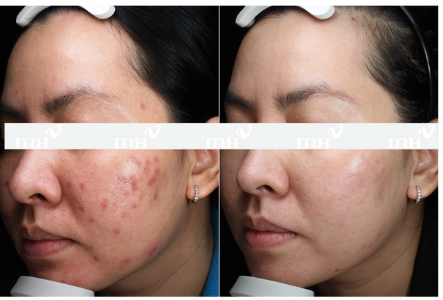 Không cần thực hiện xâm lấn, Dr.Huy Clinic làm chủ xu hướng trẻ da an toàn- Ảnh 1.