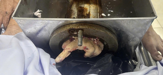 Bị máy xay thịt cuốn tay, nam công nhân bị cắt cụt tới 1/3 trên cẳng tay- Ảnh 1.