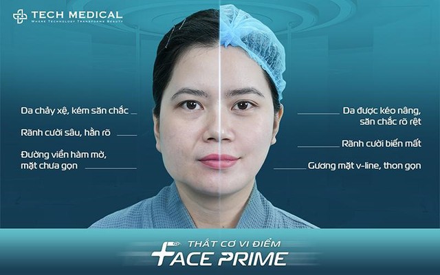 Thắt cơ vi điểm, giải pháp trẻ hóa phù hợp với nhiều đối tượng làm đẹp- Ảnh 2.