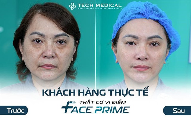 Thắt cơ vi điểm, giải pháp trẻ hóa phù hợp với nhiều đối tượng làm đẹp- Ảnh 3.