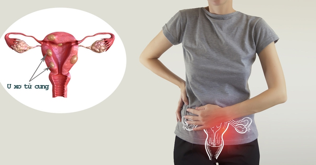 U xơ tử cung có gây hiếm muộn không?- Ảnh 1.