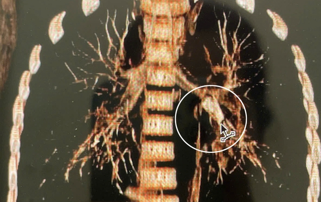  Đang ngồi học bỗng tím tái, bé trai 7 tuổi khiến bác sĩ hốt hoảng khi soi phế quản- Ảnh 1.
