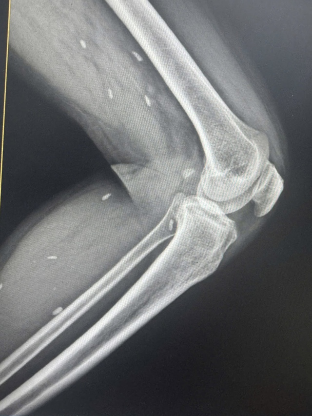 
Phát hiện nhiều kén sán ở chân bệnh nhân do một thói quen thường gặp- Ảnh 1.