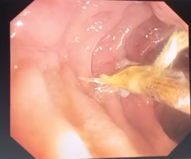 Thủng tá tràng do thói quen ngậm tăm xỉa răng- Ảnh 1.