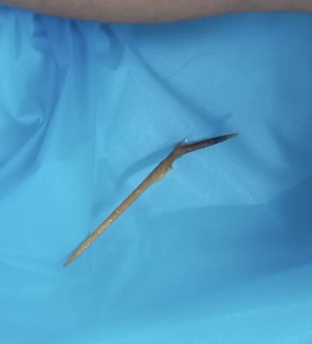 Thủng tá tràng do thói quen ngậm tăm xỉa răng- Ảnh 2.