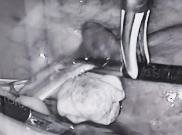 Ứng dụng dao siêu âm công nghệ cao phẫu thuật đa u xơ tử cung phức tạp- Ảnh 1.