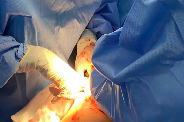 Thai phụ 34 tuần nguy kịch vì u buồng trứng xoắn hoại tử- Ảnh 1.