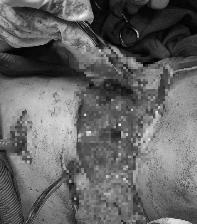 Cứu sống bệnh nhân nguy kịch có vết thương nghiêm trọng vùng cổ- Ảnh 1.