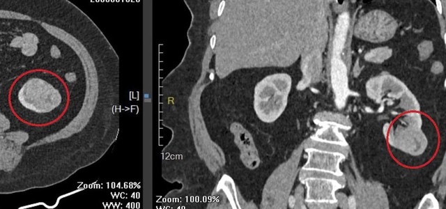 Mổ ruột thừa, bác sĩ phát hiện ung thư thận ở bệnh nhân 76 tuổi- Ảnh 1. Mổ ruột thừa, bác sĩ phát hiện ung thư thận ở bệnh nhân 76 tuổi- Ảnh 1.