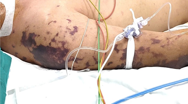 Người đàn ông khó thở, tím tái sau 2 ngày ăn cỗ- Ảnh 2.