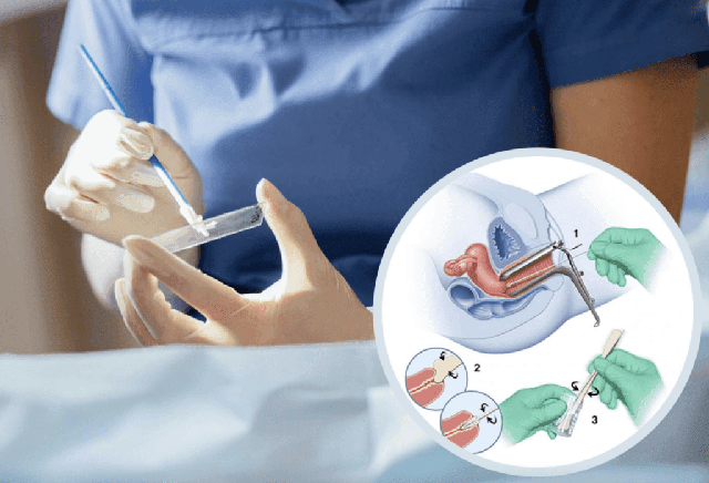 Khi nào nên làm xét nghiệm Pap để sàng lọc ung thư cổ tử cung?- Ảnh 1. Khi nào nên làm xét nghiệm Pap để sàng lọc ung thư cổ tử cung?- Ảnh 1.