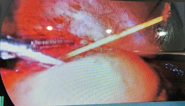 Nuốt tăm tre, người phụ nữ 35 tuổi bị áp xe ổ bụng phải mổ cấp cứu- Ảnh 1.