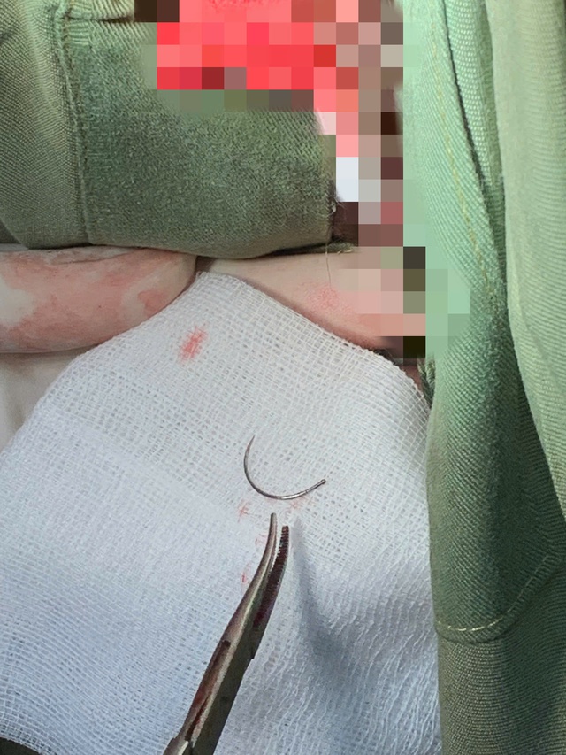 Kim khâu 'mắc kẹt' 11 năm ở tầng sinh môn của bệnh nhân- Ảnh 1.