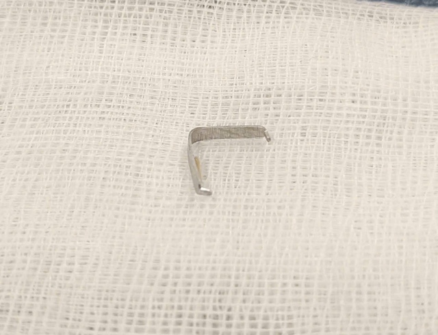 Ghim tất sắc nhọn mắc trong họng bé trai- Ảnh 2. Ghim tất sắc nhọn mắc trong họng bé trai- Ảnh 2.