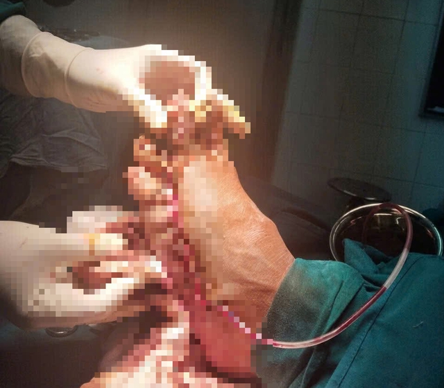 Người đàn ông suýt mất bàn chân vì máy cắt cỏ- Ảnh 1.