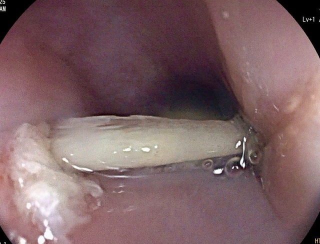 Liên tiếp ca mắc dị vật nguy hiểm, bác sĩ cảnh báo nguy cơ đe dọa tính mạng- Ảnh 3.