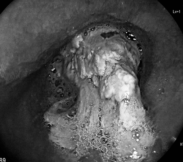 Liên tiếp ca mắc dị vật nguy hiểm, bác sĩ cảnh báo nguy cơ đe dọa tính mạng- Ảnh 2.