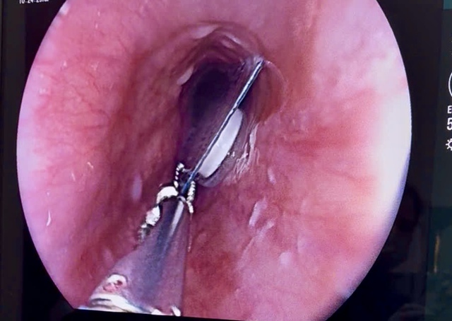 Liên tiếp ca mắc dị vật nguy hiểm, bác sĩ cảnh báo nguy cơ đe dọa tính mạng- Ảnh 1.