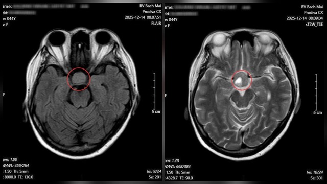 Nhìn mờ kéo dài, người phụ nữ phát hiện u tuyến yên nhờ khám mắt- Ảnh 2.
