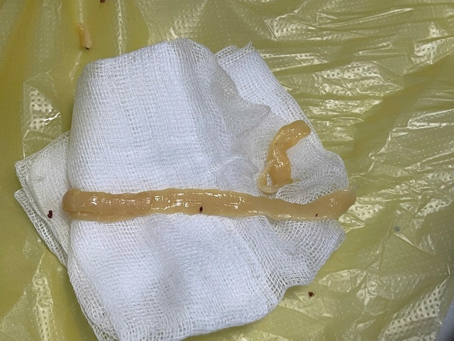 Người đàn ông hay ăn đồ sống và tiết canh, nhiễm sán dây gần 1m- Ảnh 1. Người đàn ông hay ăn đồ sống và tiết canh, nhiễm sán dây gần 1m- Ảnh 1.