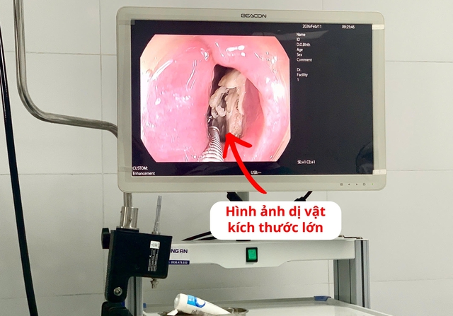 Lấy xương gà kích thước lớn mắc kẹt trong thực quản bệnh nhân- Ảnh 1.