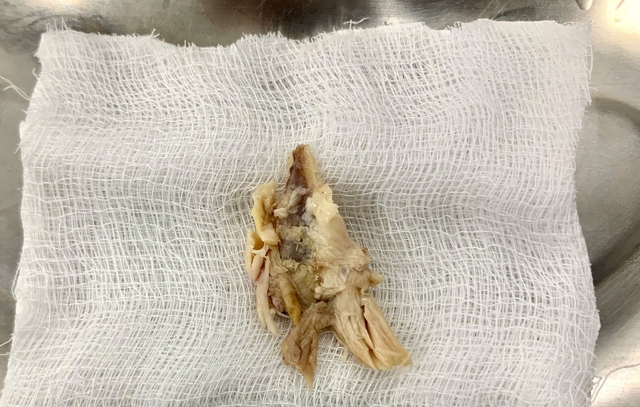 Lấy xương gà kích thước lớn mắc kẹt trong thực quản bệnh nhân- Ảnh 2.