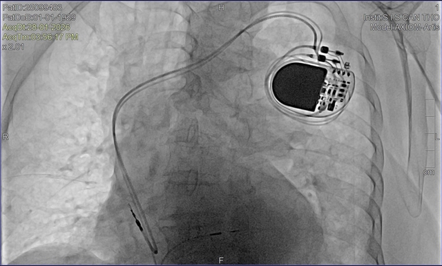 Cụ bà U100 vẫn được tiếp cận kỹ thuật tim mạch hiện đại ngay tại Tây Nam Bộ- Ảnh 1.