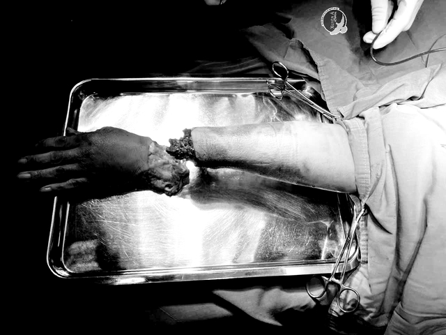 Nỗ lực giữ lại bàn tay công nhân bị dập nát do tai nạn lao động- Ảnh 1.