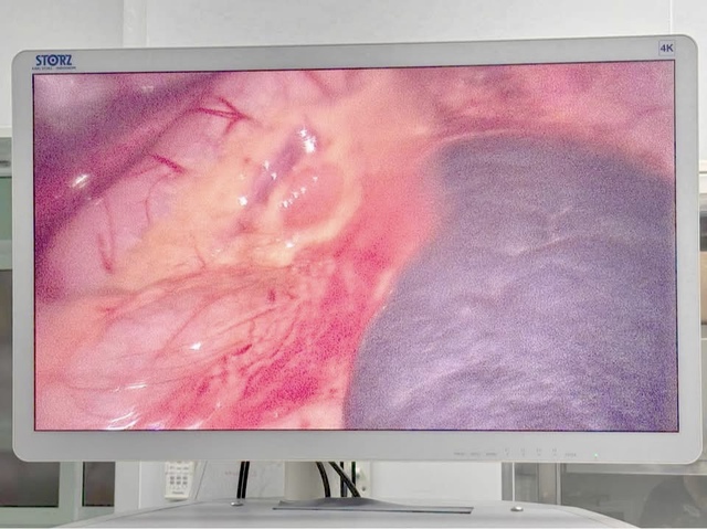 Phẫu thuật nội soi xử lý ca lách xoắn hiếm gặp ở trẻ 40 tháng tuổi- Ảnh 2.