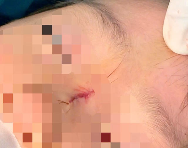 Sưng sống mũi kéo dài ở trẻ, bác sĩ cảnh báo dị tật hiếm gặp- Ảnh 1.