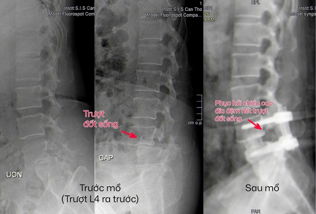 Trượt đốt sống sau té ngã, bệnh nhân được cứu bằng mổ nội soi ít xâm lấn- Ảnh 1.