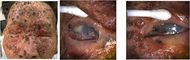 Nhiều ca tổn thương mắt nặng, nguy cơ mù lòa vĩnh viễn do nổ pháo- Ảnh 2.