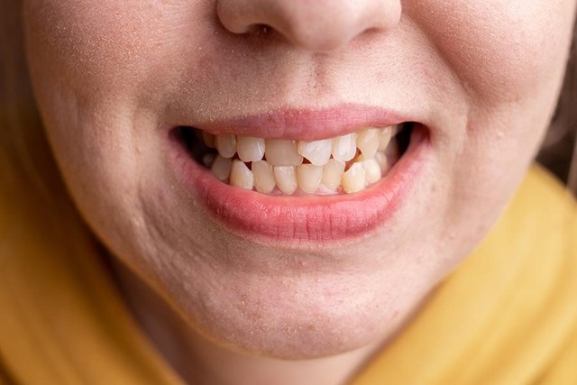 30 tuổi còn niềng răng được không? Phương pháp nào phù hợp?- Ảnh 1. 30 tuổi còn niềng răng được không? Phương pháp nào phù hợp?- Ảnh 1.