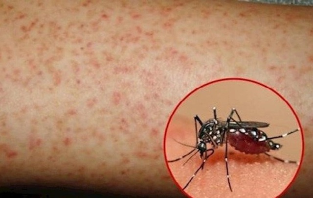 Nguy cơ dịch sốt xuất huyết gia tăng, Lâm Đồng yêu cầu tăng cường giám sát dịch- Ảnh 1. Nguy cơ dịch sốt xuất huyết gia tăng, Lâm Đồng yêu cầu tăng cường giám sát dịch- Ảnh 1.