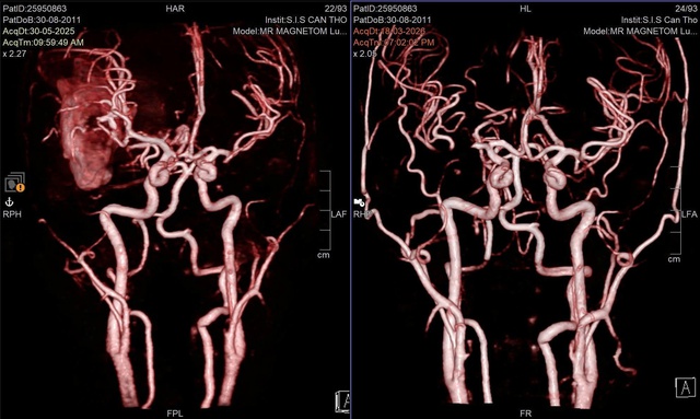 Giữ lại giấc mơ làm họa sĩ cho nam sinh lớp 8 sau cơn xuất huyết não nguy kịch- Ảnh 1.