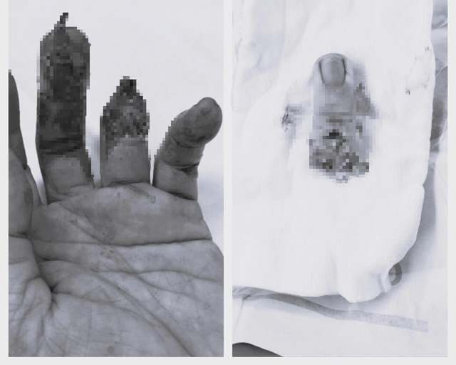 5 giờ liên tục bác sĩ viện tỉnh nối thành công ngón tay đứt lìa cho bệnh nhân- Ảnh 1. 5 giờ liên tục bác sĩ viện tỉnh nối thành công ngón tay đứt lìa cho bệnh nhân- Ảnh 1.