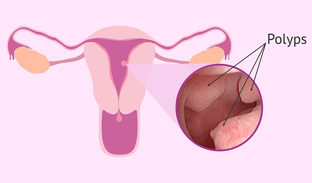 Dấu hiệu cảnh báo polyp nội mạc tử cung cần đi khám- Ảnh 1.