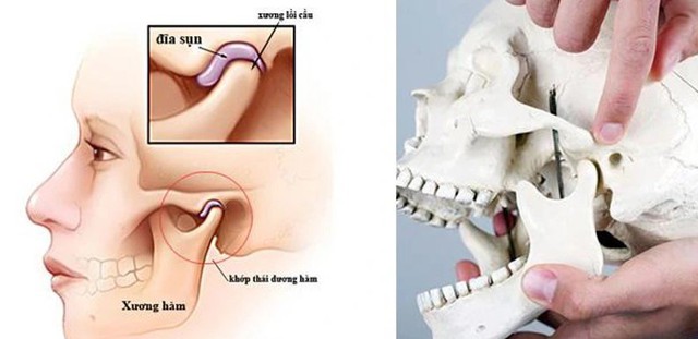 Dinh dưỡng hỗ trợ phòng ngừa biến chứng của viêm khớp thái dương hàm- Ảnh 1. Dinh dưỡng hỗ trợ phòng ngừa biến chứng của viêm khớp thái dương hàm- Ảnh 1.