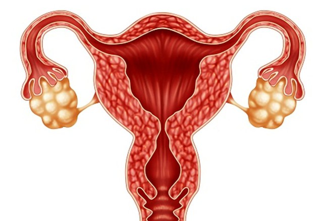 4 cách cải thiện khả năng sinh sản ở phụ nữ mắc Hội chứng buồng trứng đa nang- Ảnh 1. 4 cách cải thiện khả năng sinh sản ở phụ nữ mắc Hội chứng buồng trứng đa nang- Ảnh 1.