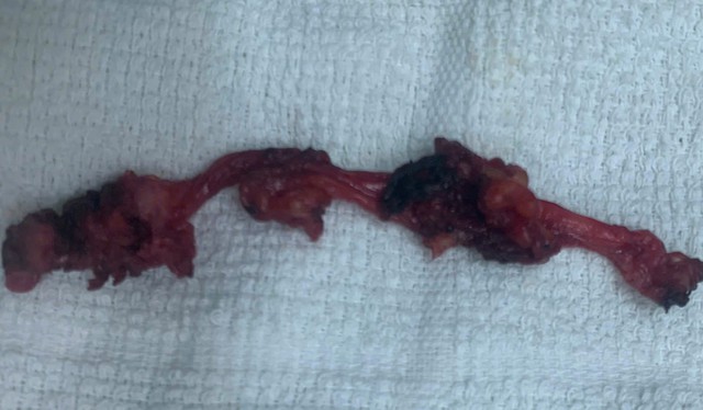 Đau âm ỉ vùng bụng, phát hiện bệnh hiếm nằm sát bàng quang- Ảnh 1. Đau âm ỉ vùng bụng, phát hiện bệnh hiếm nằm sát bàng quang- Ảnh 1.