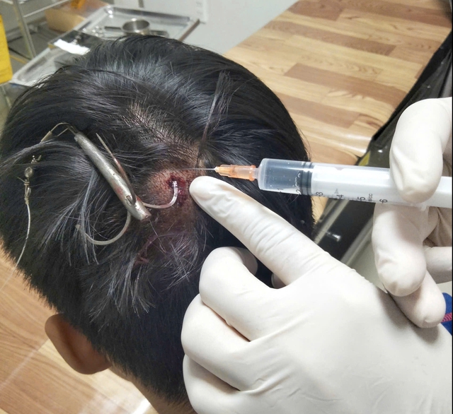 Móc câu 3 tiêu cắm sâu vào đỉnh đầu thiếu niên- Ảnh 1.