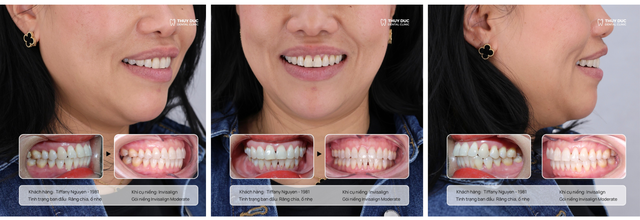 Vì sao người trưởng thành ngày càng chuộng niềng răng trong suốt Invisalign?- Ảnh 1.