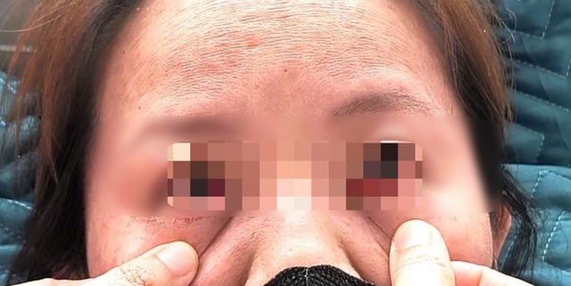 Lây sởi từ cháu gái, người phụ nữ nhập viện vì đa biến chứng- Ảnh 1.