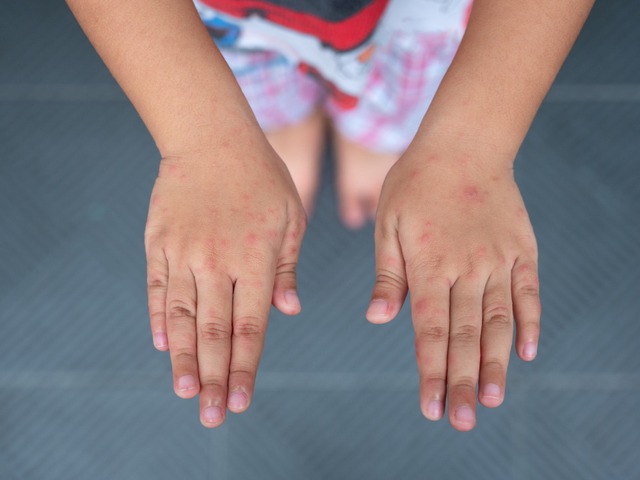 Các cấp độ bệnh tay chân miệng và dấu hiệu cảnh báo- Ảnh 2.