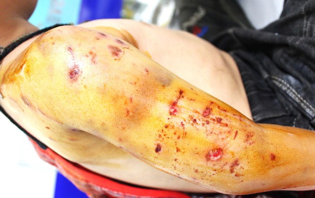 Bé 4 tuổi bị chó nhà cắn, nhiều vết thương nặng ở đầu và tay- Ảnh 1.